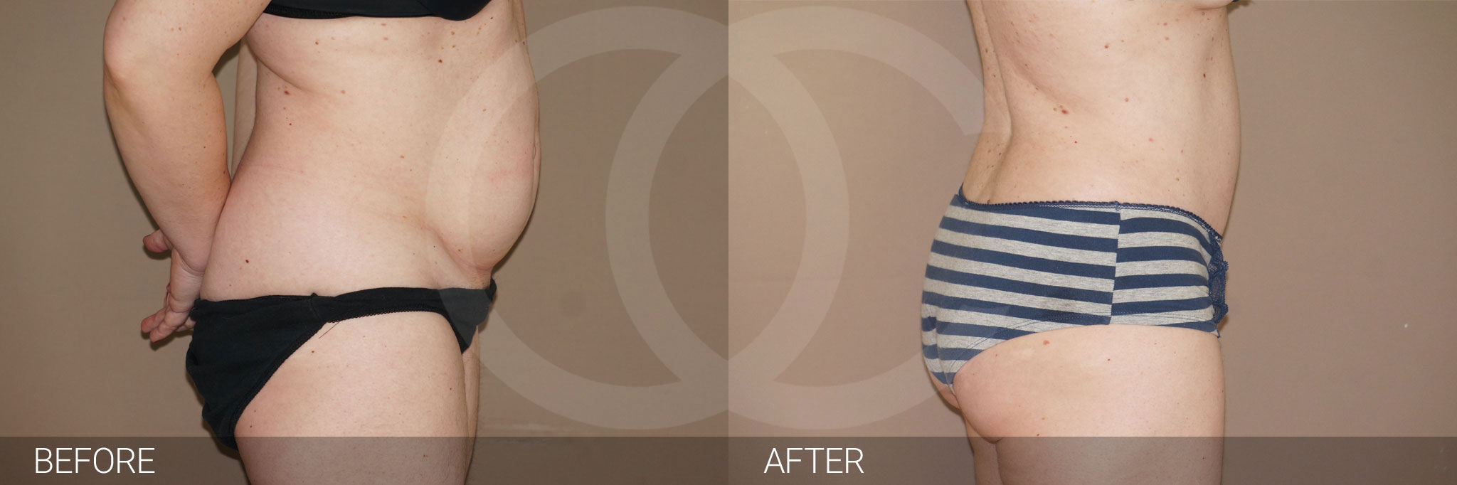 Antes y después Abdominoplastia con liposucción fotos reales de pacientes 7.3 | Ocean Clinic Marbella Madrid