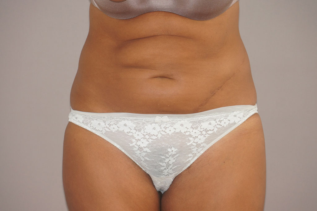 Tummy Tuck Abdominoplasty ante/post-op I