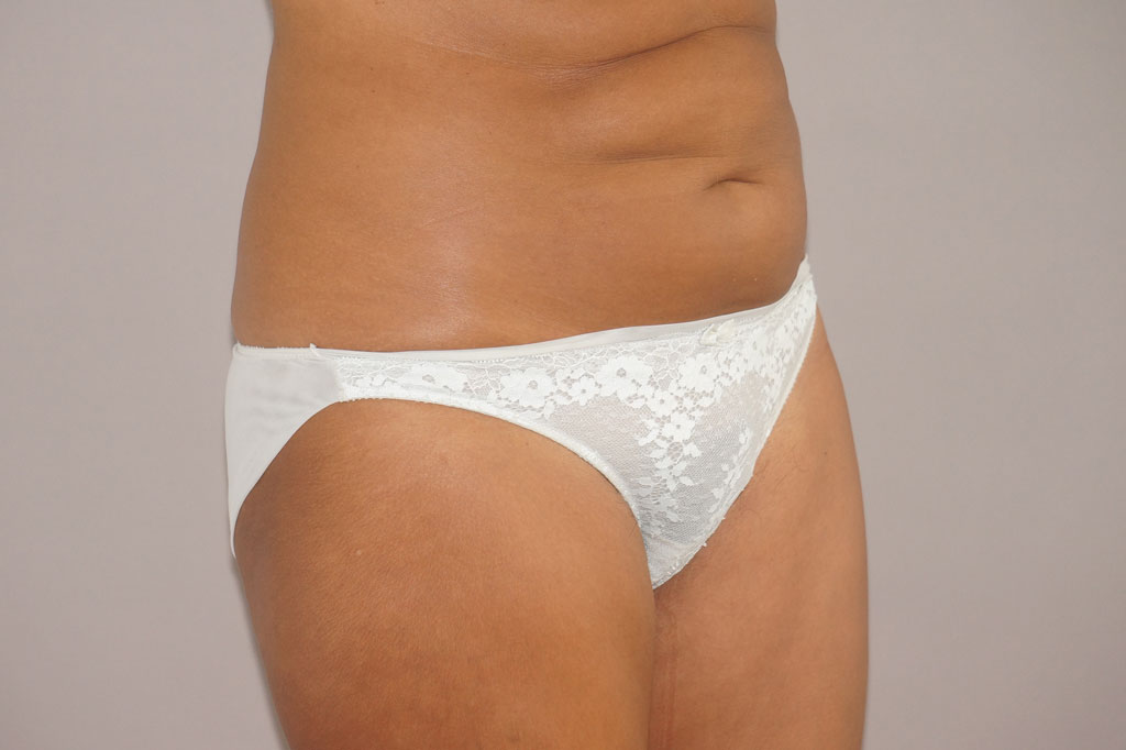 Bauchdeckenstraffung 24 BAUCHSTRAFFUNG ABDOMINOPLASTIK ÜBERSCHÜSSIGES HAUT- UND FETTGEWEBE ante-op lateral