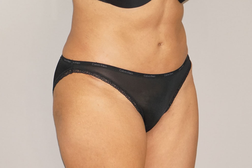 Bauchdeckenstraffung 24 BAUCHSTRAFFUNG ABDOMINOPLASTIK ÜBERSCHÜSSIGES HAUT- UND FETTGEWEBE post-op lateral