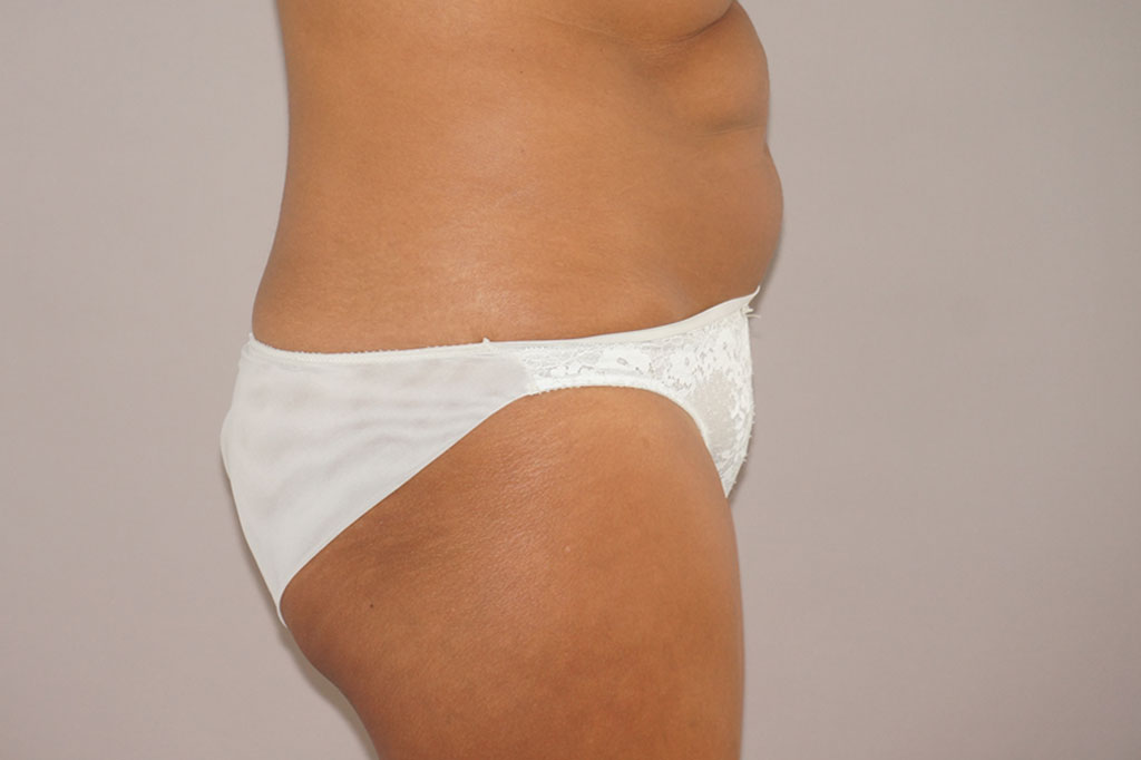 Bauchdeckenstraffung 24 BAUCHSTRAFFUNG ABDOMINOPLASTIK ÜBERSCHÜSSIGES HAUT- UND FETTGEWEBE ante-op retro/lateral