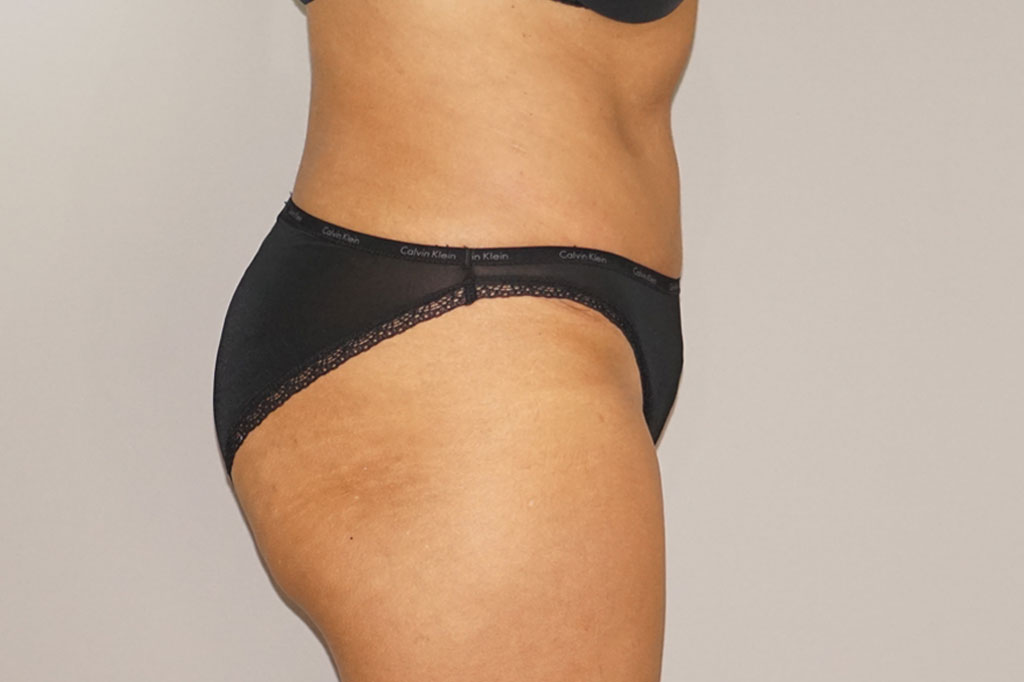 Bauchdeckenstraffung 24 BAUCHSTRAFFUNG ABDOMINOPLASTIK ÜBERSCHÜSSIGES HAUT- UND FETTGEWEBE post-op retro/lateral