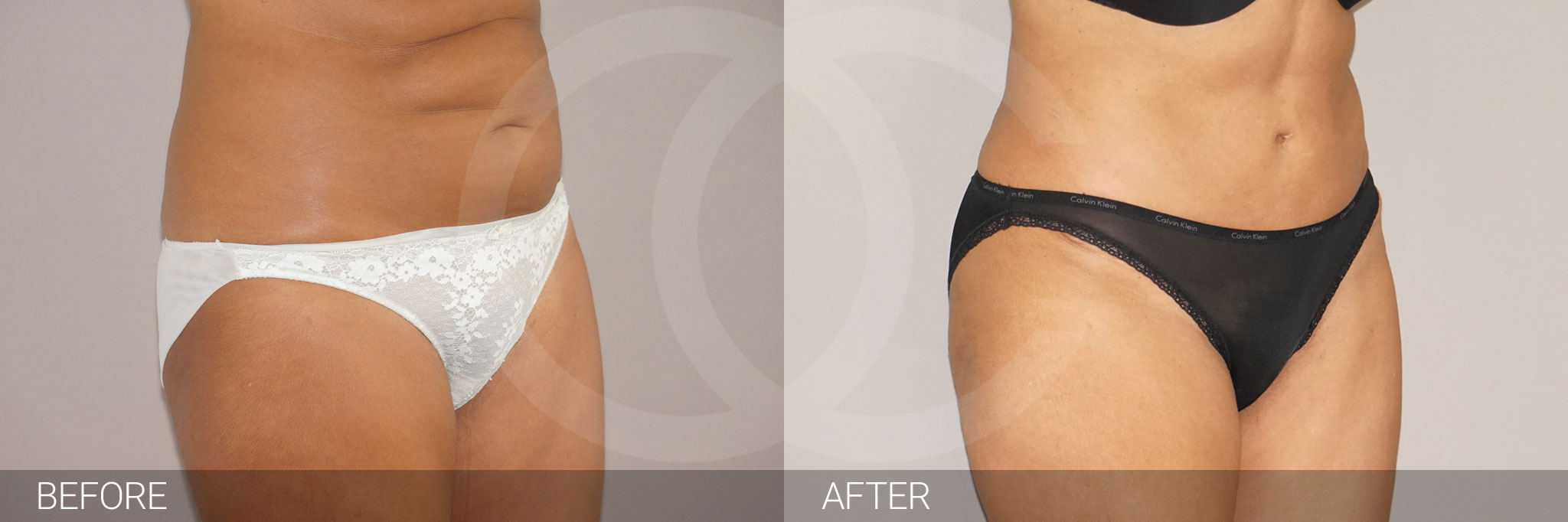 Antes y después Abdominoplastia reducción abdominal fotos reales de pacientes 9.2 | Ocean Clinic Marbella Madrid