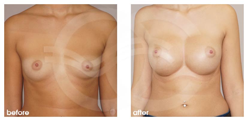 Breast Augmentation & Enlargement - before and after real clinical case 02