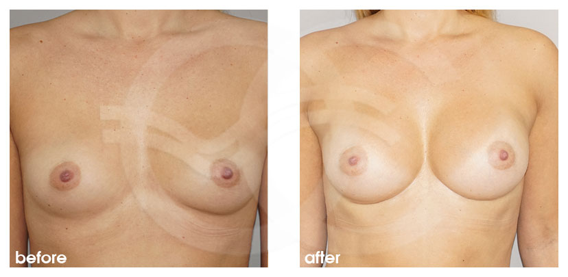 Breast Augmentation & Enlargement - before and after real clinical case 01