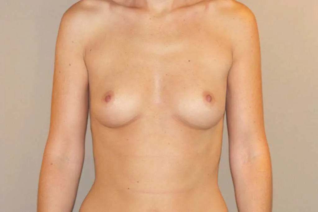 Aumento de pecho en Marbella antes de la cirugía – vista frontal