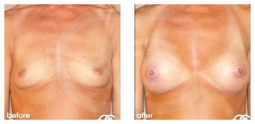 Brustvergrößerung 19 BRUSTIMPLANTATE SILIKON 280CC ANATOMISCH HIGH PROFILE before after forntal