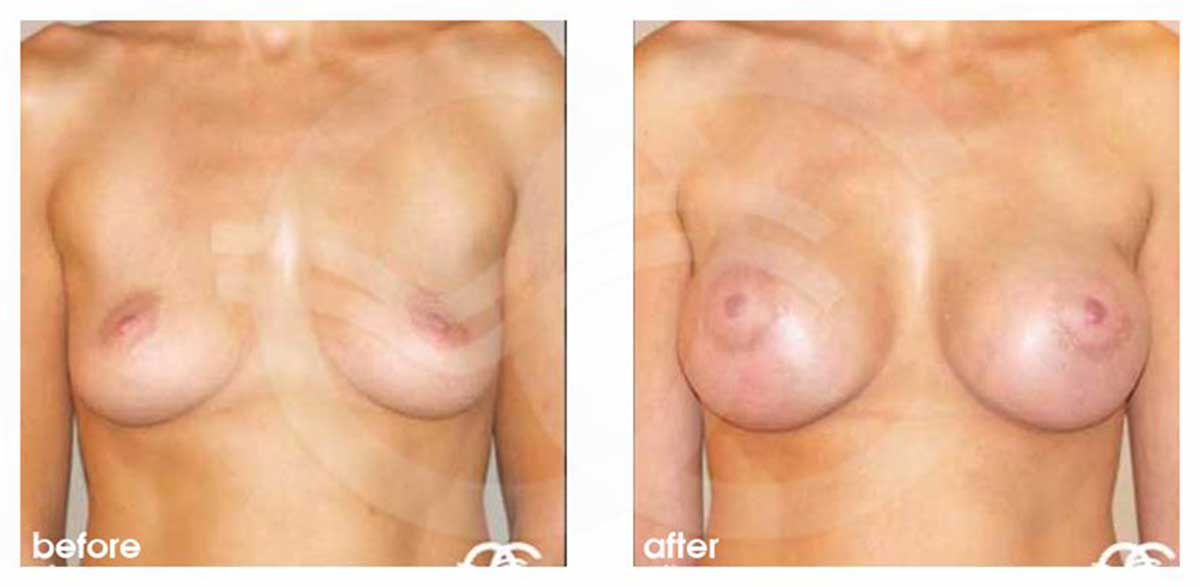 Augmentation mammaire Implants en silicone 325cc profil haut ante/post-op profil