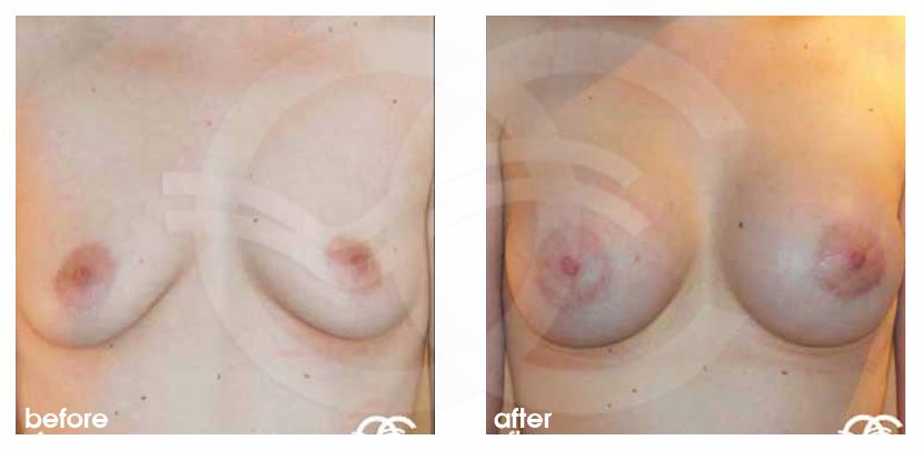 Augmentation mammaire 400cc prothèses en silicone ante/post-op profil