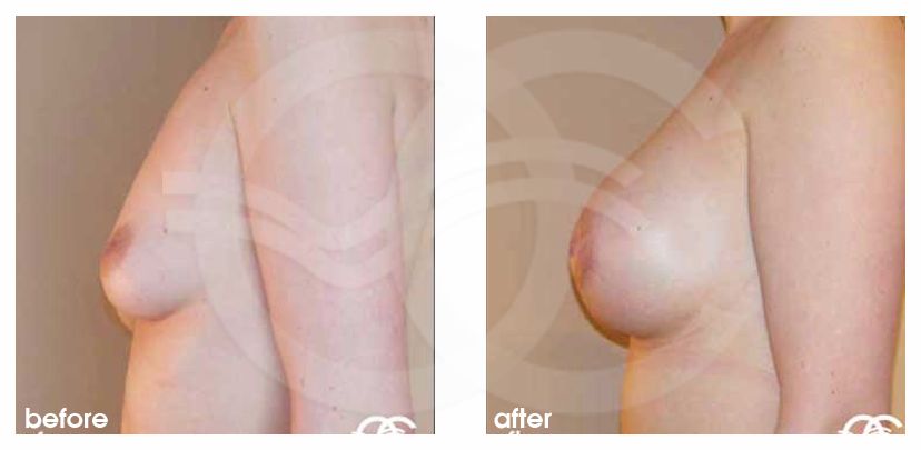 Augmentation mammaire 400cc prothèses en silicone ante/post-op retro/lateral