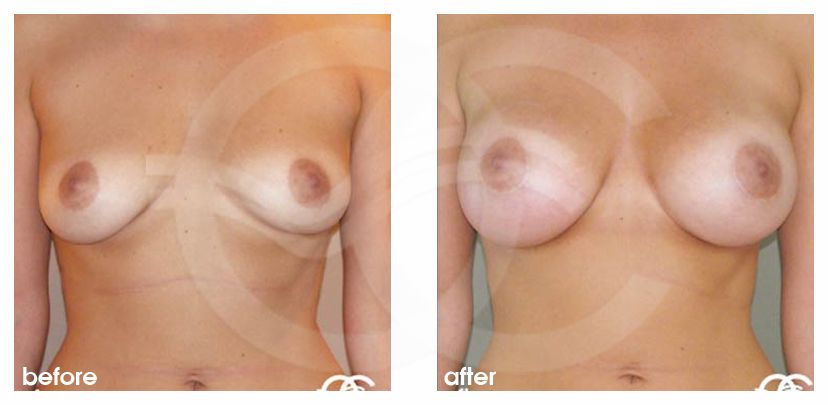 Augmentation mammaire 380cc profil haut implants mammaires en silicone  ante/post-op profil