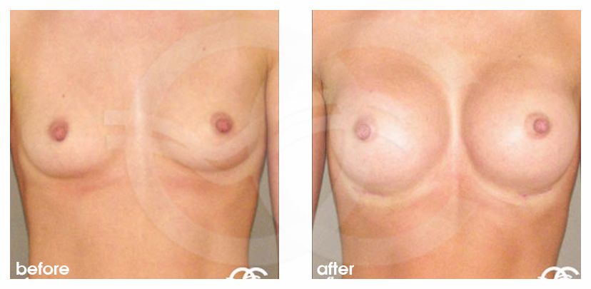 Augmentation mammaire 350cc implants mammaires en silicone profil haut ante/post-op profil