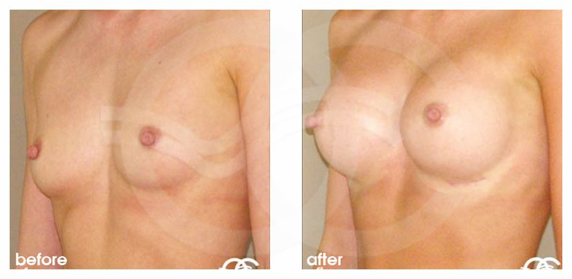 Augmentation mammaire 350cc implants mammaires en silicone profil haut ante/post-op lateral