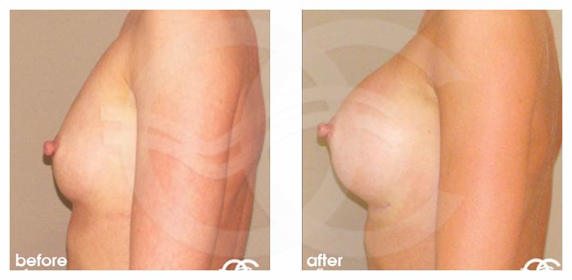 Augmentation mammaire 350cc implants mammaires en silicone profil haut ante/post-op retro/lateral