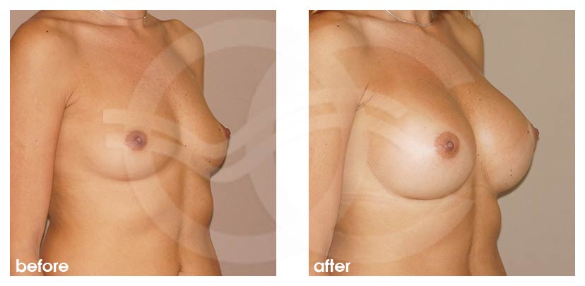 Augmentation mammaire 380cc rétro-pectorale prothèses mammaires en silicone ante/post-op lateral