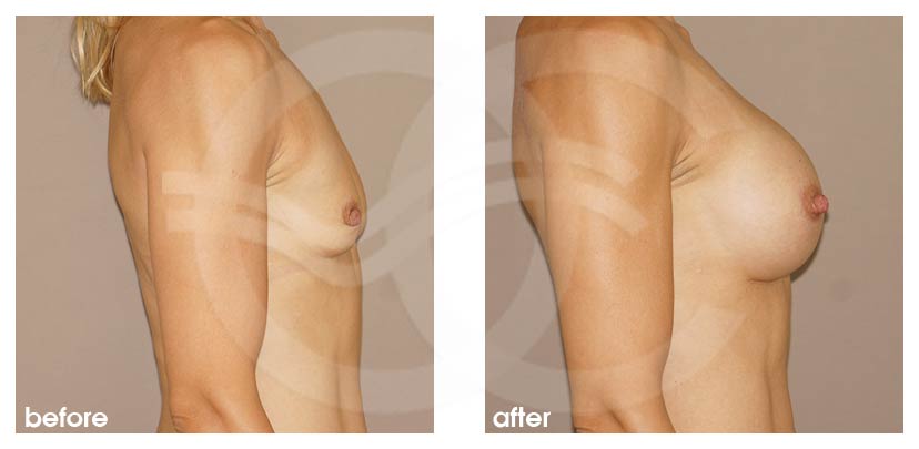 Augmentation mammaire 350cc rondes implants mammaires en silicone ante/post-op retro/lateral