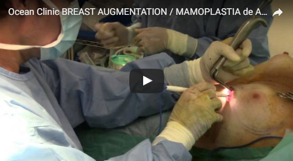 Brustvergrößerung durch Brustimplantate Video Ocean Clinic Marbella