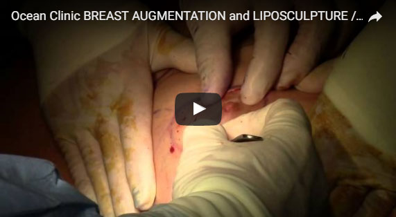 Brustvergrößerung Brust OP Brustimplantatwechsel Video Ocean Clinic Marbella