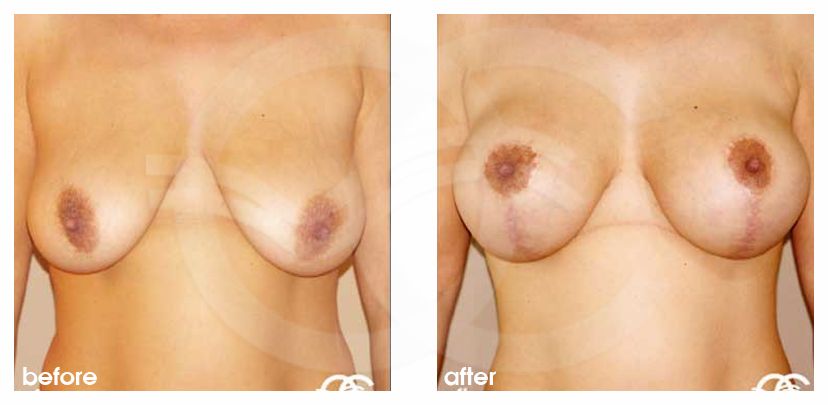 Mastopexy before and after real clinical case 02