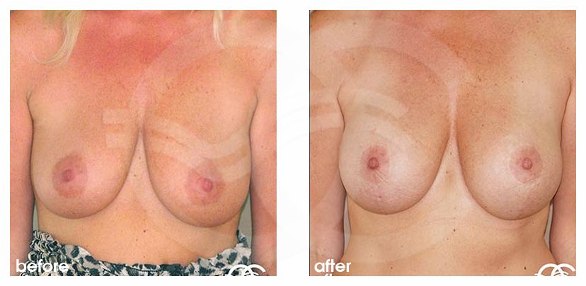 Mastopexy before and after real clinical case 01