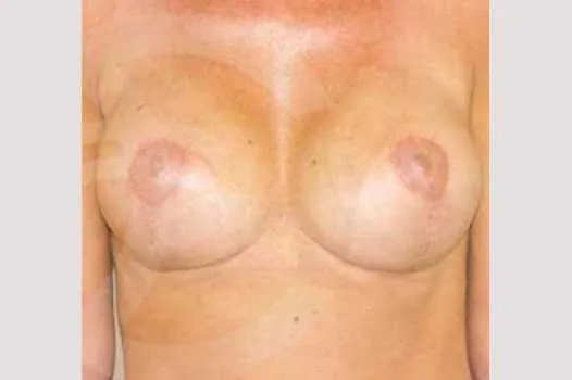Resultado después de mastopexia – vista frontal