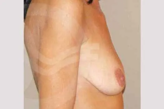 Mastopexia antes de la cirugía – vista lateral