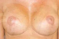 Caso real mastopexia Marbella - 02