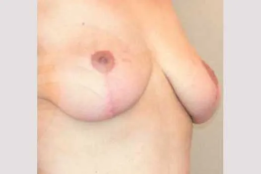 Resultado después de mastopexia –  vista 3/4