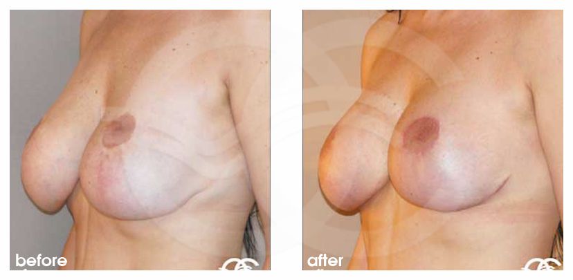 Lifting des seins 03 ante/post-op lateral