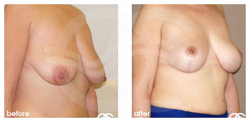Breast Lift Inverse-T Scar ante/post-op lateral