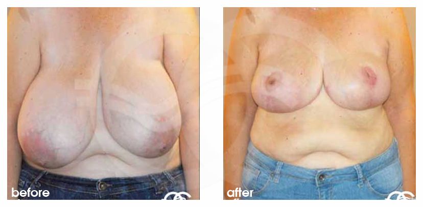 Breast reduction before and after real clinical case 02