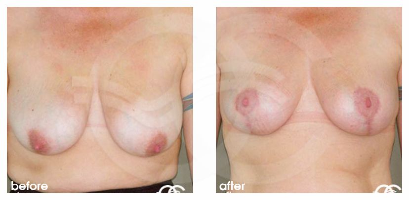 Breast reduction before and after real clinical case 03