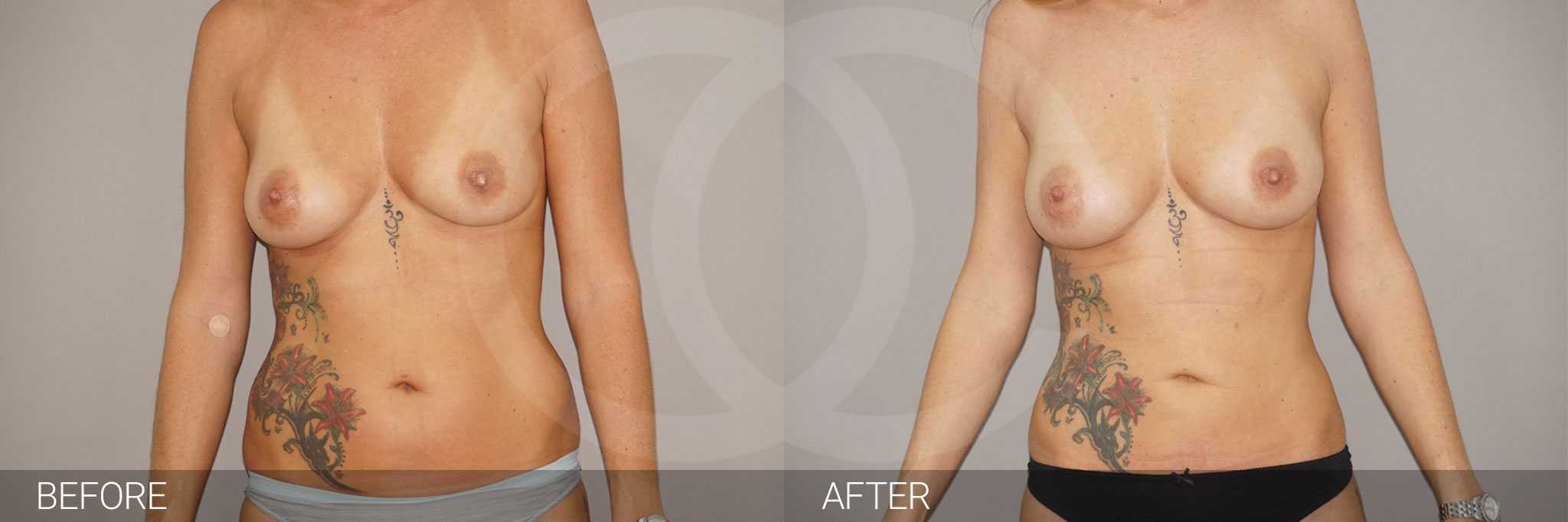 Breast Augmentation with Fat Transfer ante/post-op I