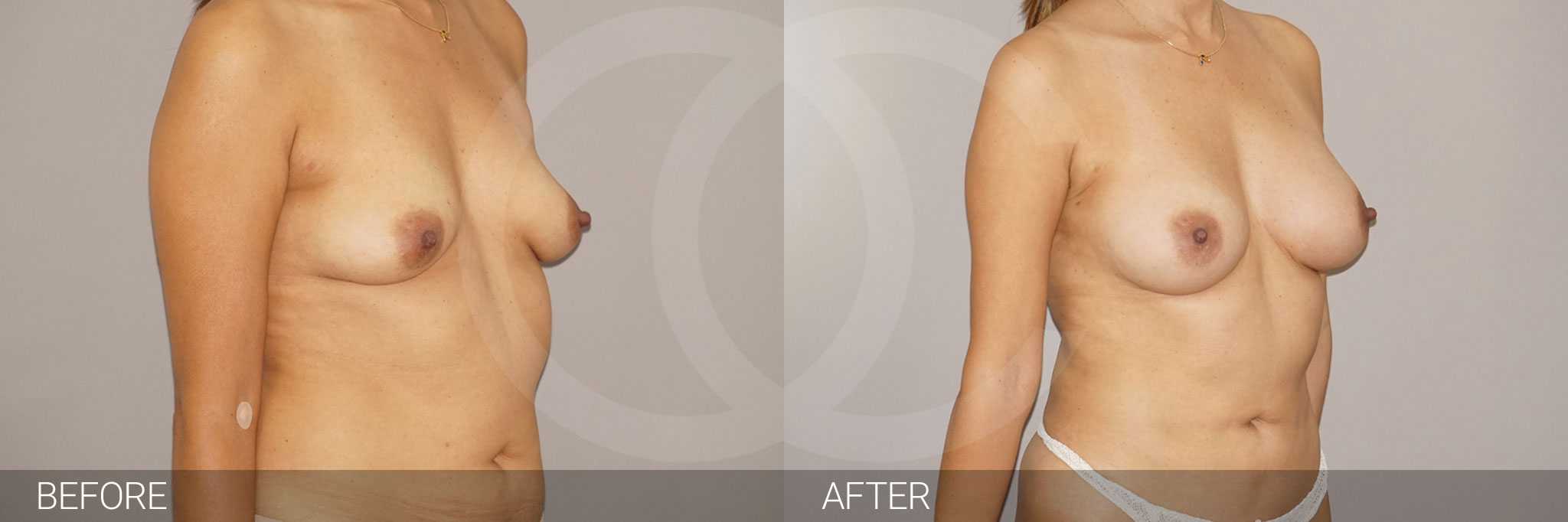 Breast augmentation with fat grafting.