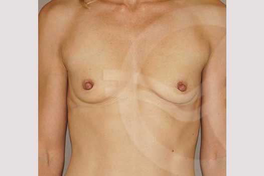 Breast Augmentation 350cc High Profile ante/post-op I