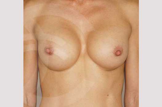 Breast Augmentation 350cc High Profile ante/post-op I