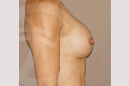 Breast Augmentation 350cc High Profile ante/post-op III