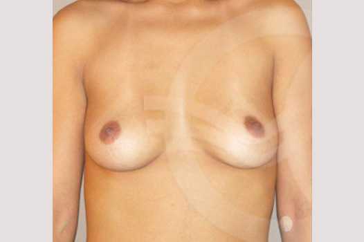 Photos Breast Augmentation  ante/post-op I