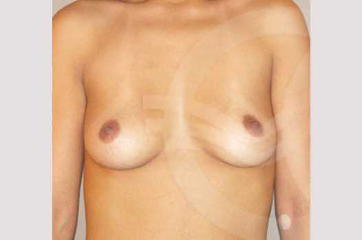 Breast Augmentation 210cc Anatomic ante/post-op I