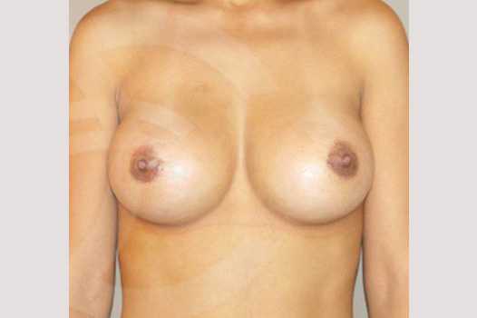 Breast Augmentation 210cc Anatomic ante/post-op I