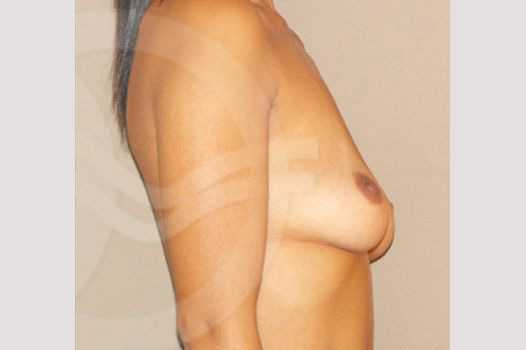 Breast Augmentation 210cc Anatomic ante/post-op III