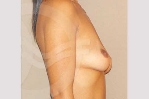 Photos Breast Augmentation  ante/post-op III