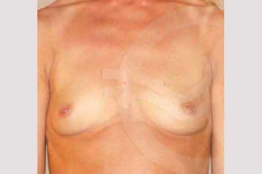 Photos Breast Augmentation  ante/post-op I