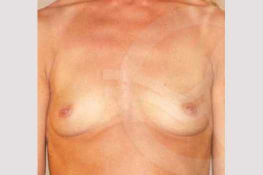 Breast Augmentation 280cc High Profile ante/post-op I