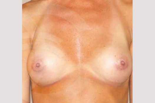 Photos Breast Augmentation  ante/post-op I