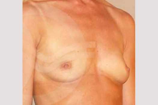 Breast Augmentation 280cc High Profile ante/post-op II