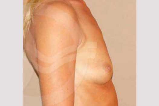 Photos Breast Augmentation  ante/post-op III