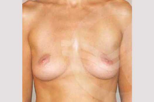 Breast Augmentation 325cc High Profile ante/post-op I