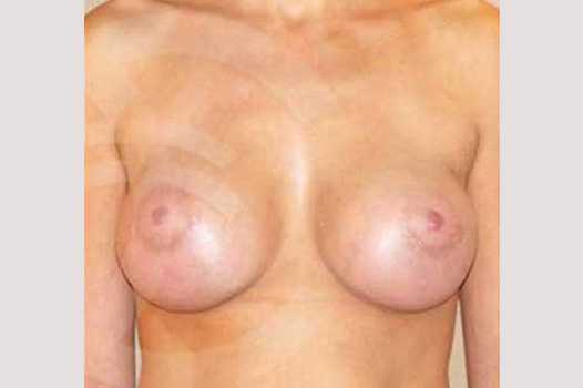 Breast Augmentation 325cc High Profile ante/post-op I