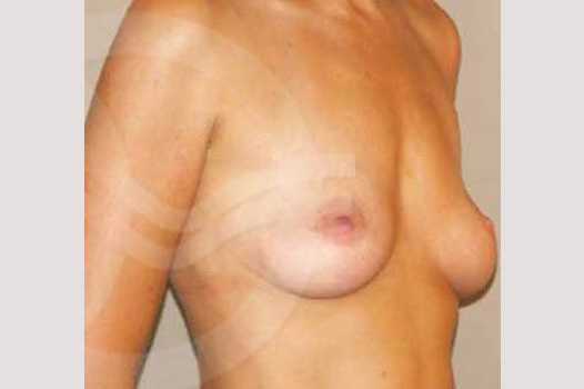 Breast Augmentation 325cc High Profile ante/post-op II
